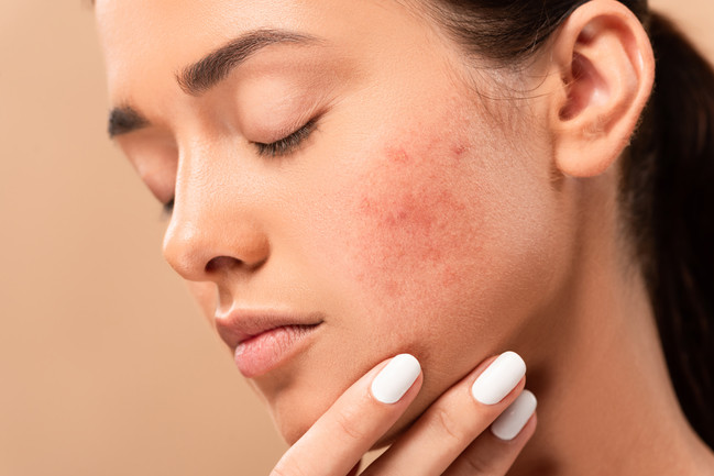 SOS Boutons ! Comment retrouver une belle peau au quotidien ? 