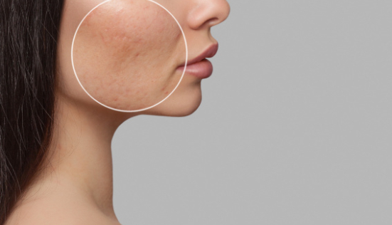 Comment atténuer les cicatrices du visage ?