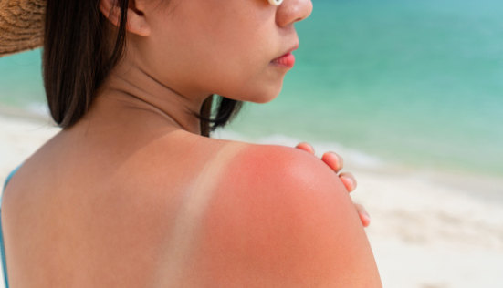 Remèdes naturels contre les coups de soleil